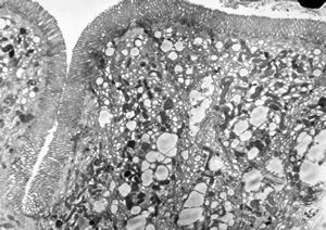 M,29y. | jejunum - lipid malabsorption